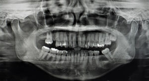 can a bad tooth cause sinus issues